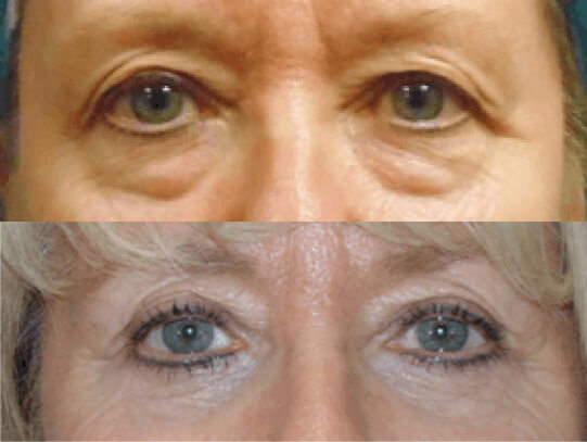 Eyelid Lift Before & After Torrance