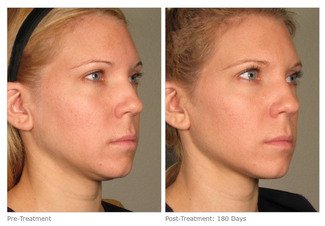 Ultherapy Before & After Torrance