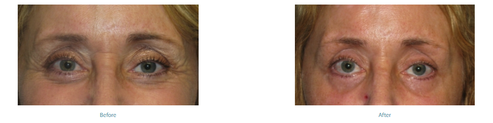 Botox Injections Torrance