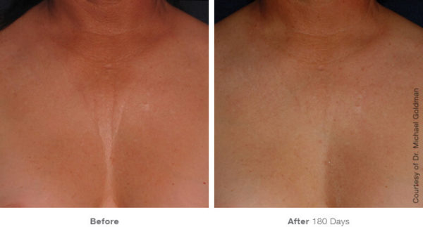 ultherapy decolletage torrance