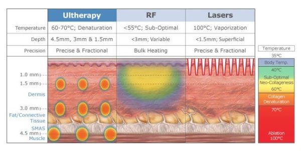 Ultherapy Overview Torrance