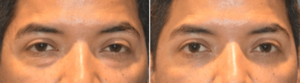 Lower Eyelid Lift Blepharoplasty Before After Torrance