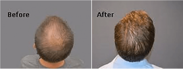 hair restoration torrance