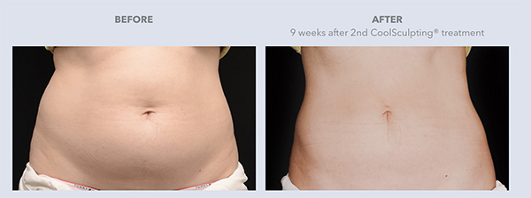 CoolSculpting-Before-After