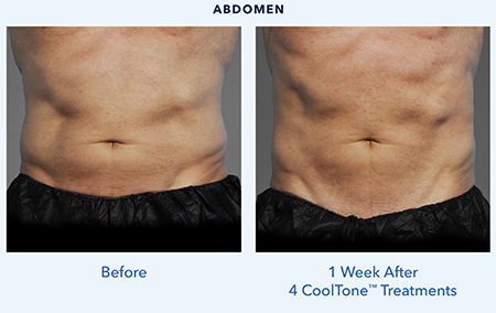 CoolTone Abdomen Male Before After